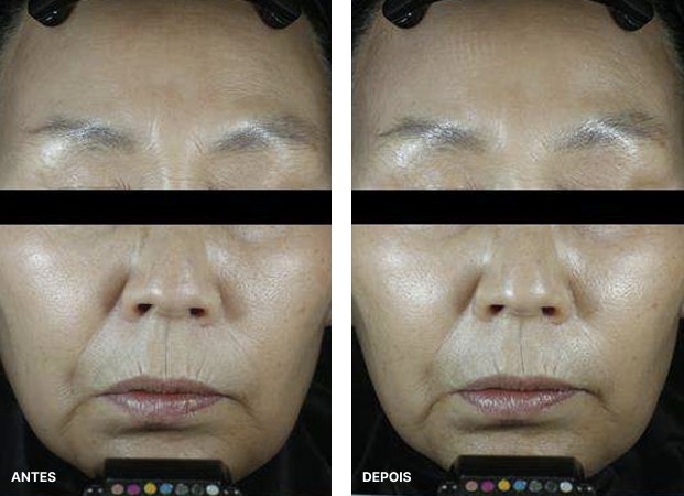 Resultados do tratamento na face